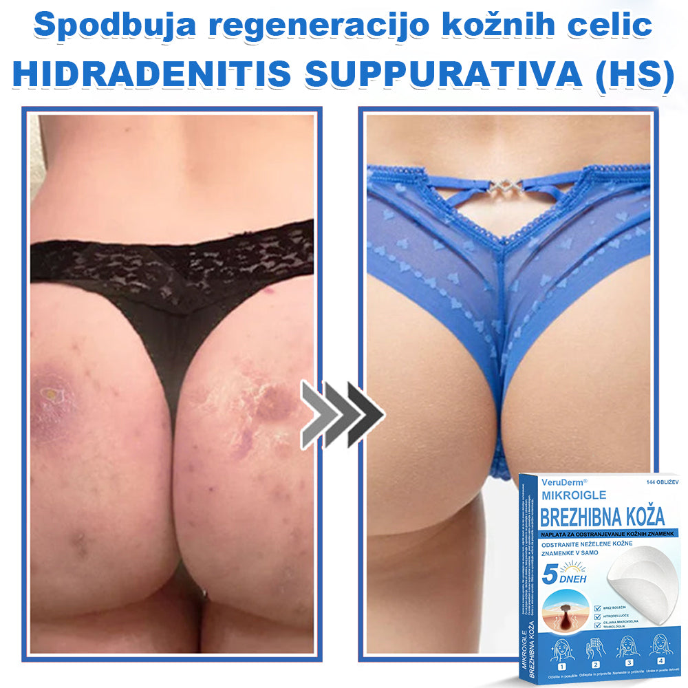 VeruDerm® 2 az 1-ben mikrotűs és hidrokolloid tapasz 🔥 | Kiemelkedő anyajegyek, pattanások, lapos szemölcsök és bőrkinövések ápolására ✅ | Segít javítani a ráncok, hegek és bőrhibák megjelenését ✨ | Láthatatlan pattanástapasz arcra és testre | 144 db 🌸