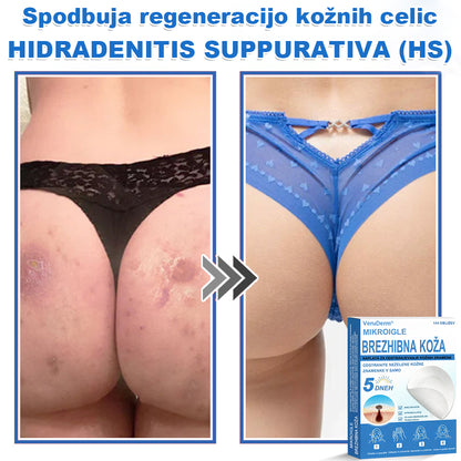 VeruDerm® 2 az 1-ben mikrotűs és hidrokolloid tapasz 🔥 | Kiemelkedő anyajegyek, pattanások, lapos szemölcsök és bőrkinövések ápolására ✅ | Segít javítani a ráncok, hegek és bőrhibák megjelenését ✨ | Láthatatlan pattanástapasz arcra és testre | 144 db 🌸
