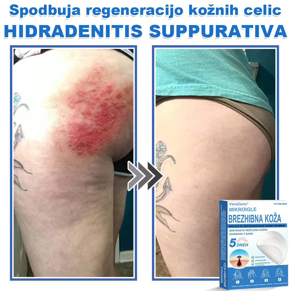 VeruDerm® 2 az 1-ben mikrotűs és hidrokolloid tapasz 🔥 | Kiemelkedő anyajegyek, pattanások, lapos szemölcsök és bőrkinövések ápolására ✅ | Segít javítani a ráncok, hegek és bőrhibák megjelenését ✨ | Láthatatlan pattanástapasz arcra és testre | 144 db 🌸
