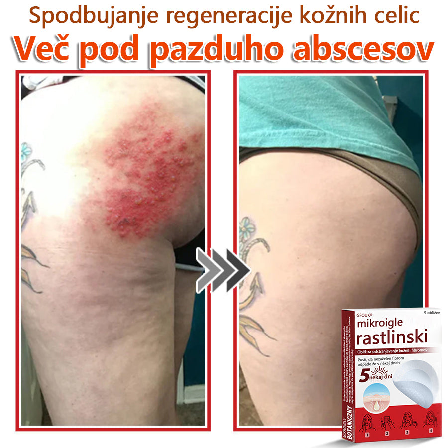 GFOUK® Rastlinski Mikronidling obliži za odstranjevanje kožnih izrastkov✨ – 🩹 Neboleče | 🚫 Brez Brazgotin | 🌿 Naravne Mikroiglice | 🎯 Globinsko Delovanje | 🛡️ Varno za Občutljivo Kožo | 📦 9 kosov | 🇪🇺 Medicinski Razred I |