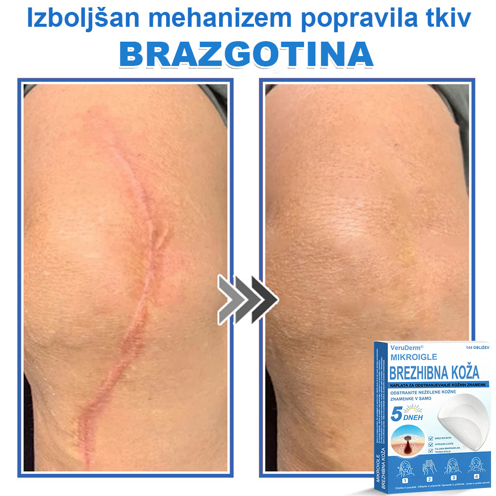 VeruDerm® 2 az 1-ben mikrotűs és hidrokolloid tapasz 🔥 | Kiemelkedő anyajegyek, pattanások, lapos szemölcsök és bőrkinövések ápolására ✅ | Segít javítani a ráncok, hegek és bőrhibák megjelenését ✨ | Láthatatlan pattanástapasz arcra és testre | 144 db 🌸