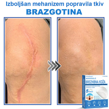 VeruDerm® 2 az 1-ben mikrotűs és hidrokolloid tapasz 🔥 | Kiemelkedő anyajegyek, pattanások, lapos szemölcsök és bőrkinövések ápolására ✅ | Segít javítani a ráncok, hegek és bőrhibák megjelenését ✨ | Láthatatlan pattanástapasz arcra és testre | 144 db 🌸