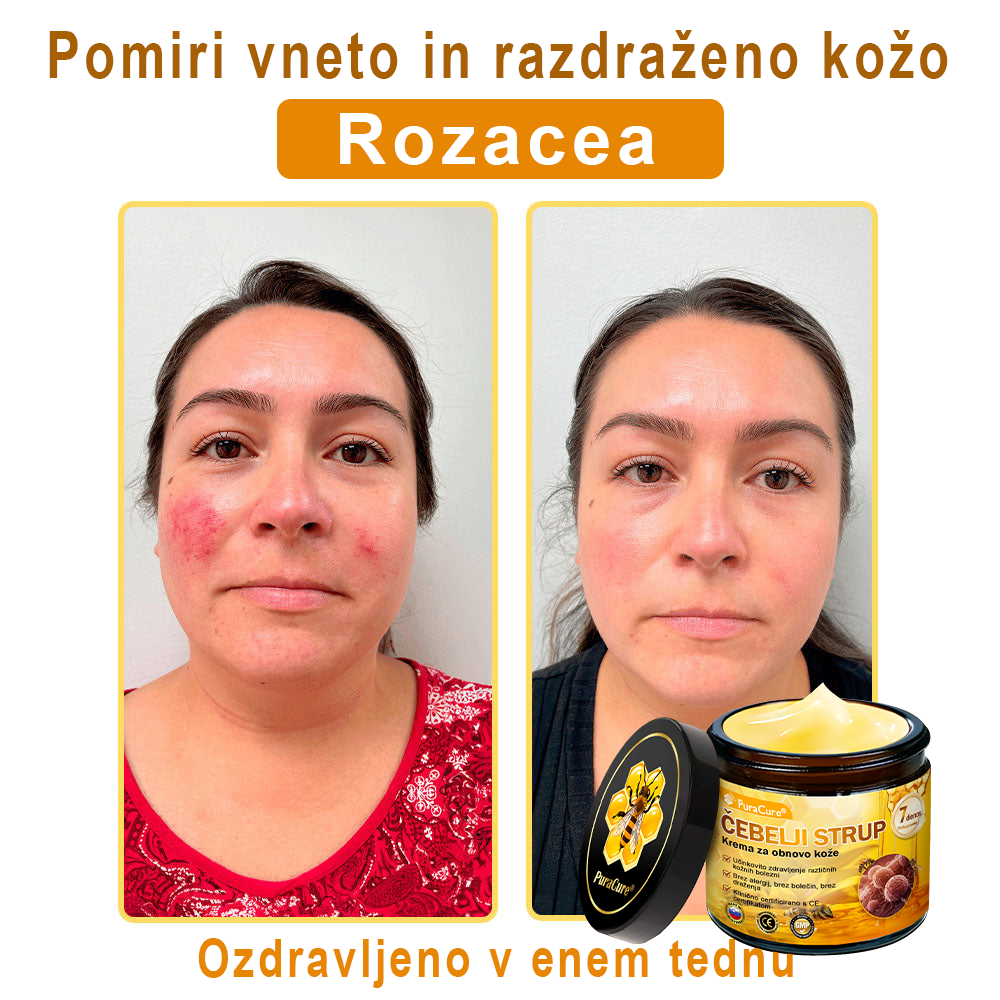 PuraCure® krema za obnovo kože s čebeljim strupom 🐝 | Naravno zdravljenje ekcema, luskavice, dermatitisa in draženja kože | Pomirjujoča in regenerativna formula  🔥