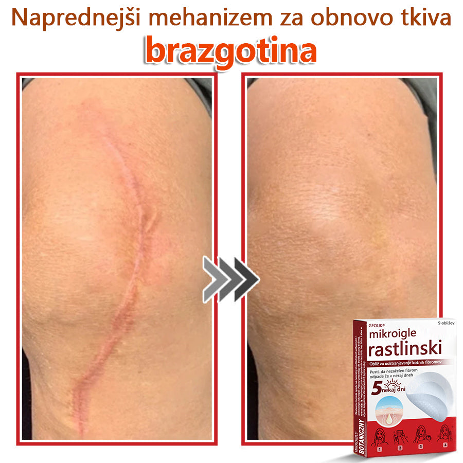 GFOUK® Rastlinski Mikronidling obliži za odstranjevanje kožnih izrastkov✨ – 🩹 Neboleče | 🚫 Brez Brazgotin | 🌿 Naravne Mikroiglice | 🎯 Globinsko Delovanje | 🛡️ Varno za Občutljivo Kožo | 📦 9 kosov | 🇪🇺 Medicinski Razred I |