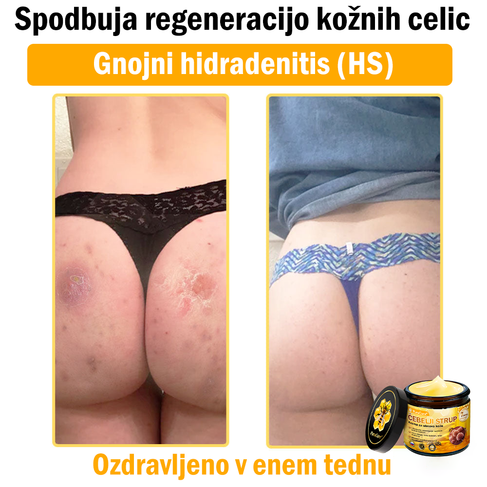 PuraCure® krema za obnovo kože s čebeljim strupom 🐝 | Naravno zdravljenje ekcema, luskavice, dermatitisa in draženja kože | Pomirjujoča in regenerativna formula  🔥