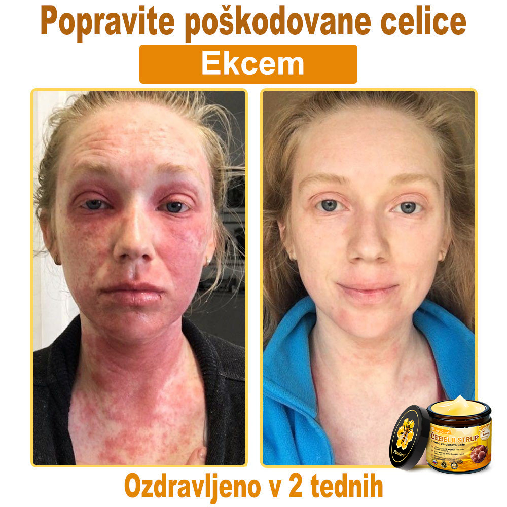 PuraCure® krema za obnovo kože s čebeljim strupom 🐝 | Naravno zdravljenje ekcema, luskavice, dermatitisa in draženja kože | Pomirjujoča in regenerativna formula  🔥