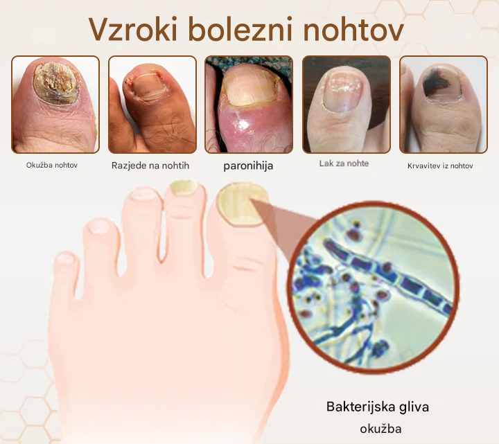 💥 2026 Omejeno 70 % CENEJE ️⏳ Hudros® NailRescue Kolirin pršilo proti glivicam s čebeljim strupom 💥 Vse težave z nohti lahko pozdravite v 2 tednih🐝