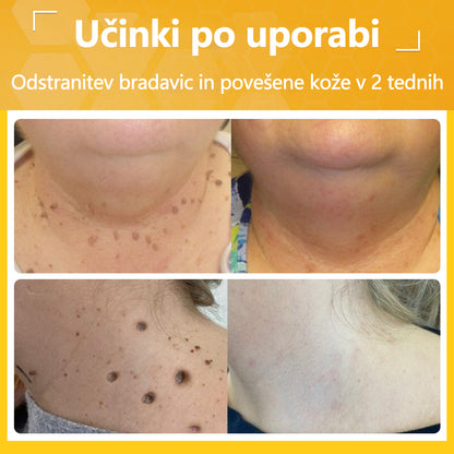 🐝Twinsun™ Izjemno Močna Krema z Čebeljim Strupom, s certifikatom EMA💖 Za zdravljenje bradavic, kožnih izrastkov, okužb in keratoze, ter za glajenje neenakomerne kože