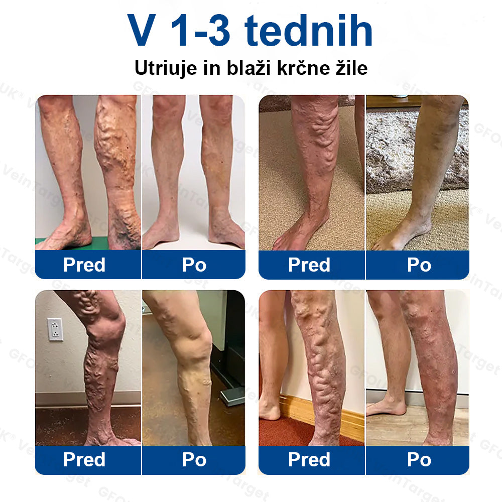 ✨ Twisma® VeinTarget: Napreden transdermalni sistem za zdravljenje kronične venske insuficience 🌿  Prvi EU-certificiran 🇪🇺 in GMP-certificiran ⚕️ alpski zeliščni mikroigelni obliž. Klinično dokazana 96-odstotna uspešnost 📊 Vidni rezultati v 7–14 dneh 🔥🔥