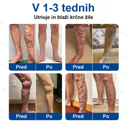 ✨ Twisma® VeinTarget: Napreden transdermalni sistem za zdravljenje kronične venske insuficience 🌿  Prvi EU-certificiran 🇪🇺 in GMP-certificiran ⚕️ alpski zeliščni mikroigelni obliž. Klinično dokazana 96-odstotna uspešnost 📊 Vidni rezultati v 7–14 dneh 🔥🔥
