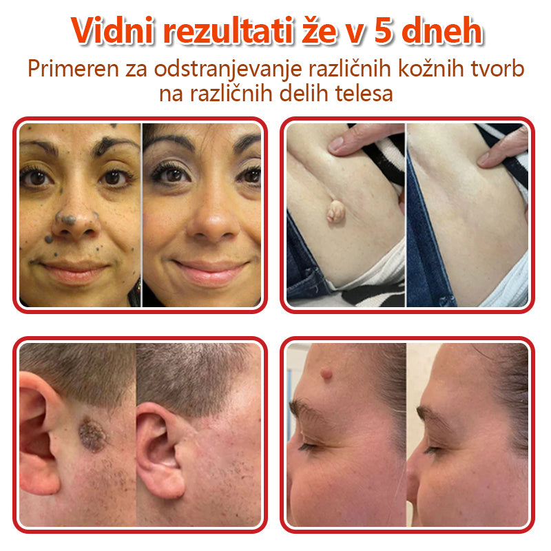 GFOUK® Rastlinski Mikronidling obliži za odstranjevanje kožnih izrastkov✨ – 🩹 Neboleče | 🚫 Brez Brazgotin | 🌿 Naravne Mikroiglice | 🎯 Globinsko Delovanje | 🛡️ Varno za Občutljivo Kožo | 📦 9 kosov | 🇪🇺 Medicinski Razred I |