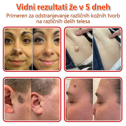GFOUK® Rastlinski Mikronidling obliži za odstranjevanje kožnih izrastkov✨ – 🩹 Neboleče | 🚫 Brez Brazgotin | 🌿 Naravne Mikroiglice | 🎯 Globinsko Delovanje | 🛡️ Varno za Občutljivo Kožo | 📦 9 kosov | 🇪🇺 Medicinski Razred I |