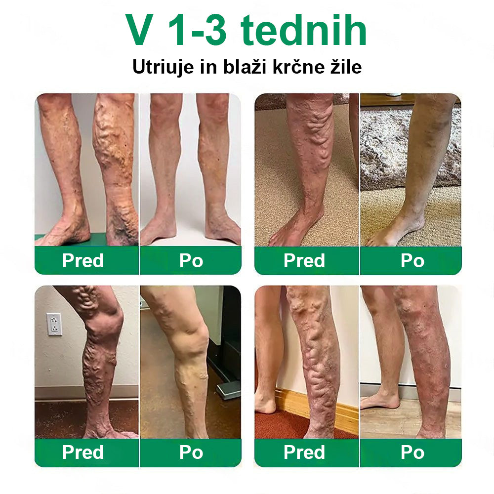 Posebna ponudba: do 70 % popusta! 🎁 Twisma® VeinTarget – napredni mikroobliž za krčne žile 🔥 96 % klinično dokazana učinkovitost ⚡ Vidni rezultati že v 7–14 dneh 🌿 Nežen podporni učinek za lažje in sproščene noge 🦵💪