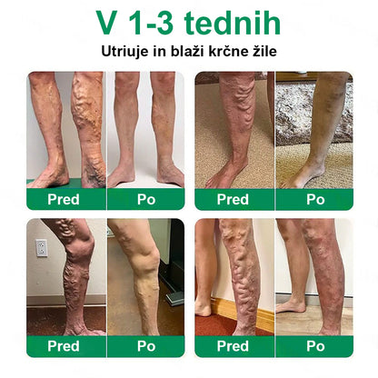 Posebna ponudba: do 70 % popusta! 🎁 Twisma® VeinTarget – napredni mikroobliž za krčne žile 🔥 96 % klinično dokazana učinkovitost ⚡ Vidni rezultati že v 7–14 dneh 🌿 Nežen podporni učinek za lažje in sproščene noge 🦵💪
