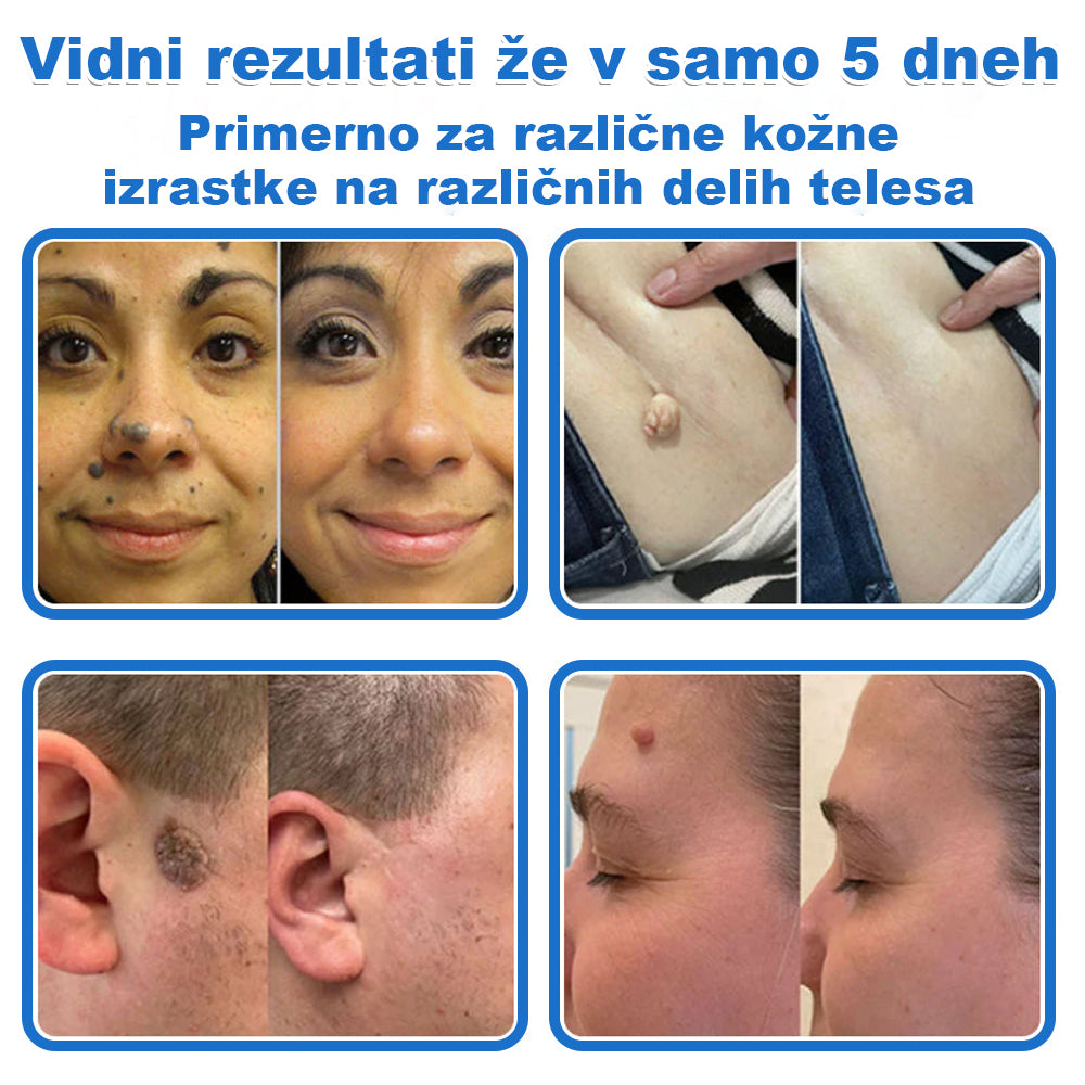 VeruDerm® 2 az 1-ben mikrotűs és hidrokolloid tapasz 🔥 | Kiemelkedő anyajegyek, pattanások, lapos szemölcsök és bőrkinövések ápolására ✅ | Segít javítani a ráncok, hegek és bőrhibák megjelenését ✨ | Láthatatlan pattanástapasz arcra és testre | 144 db 🌸