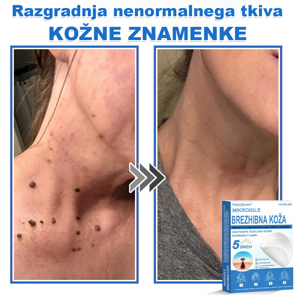 VeruDerm® 2 az 1-ben mikrotűs és hidrokolloid tapasz 🔥 | Kiemelkedő anyajegyek, pattanások, lapos szemölcsök és bőrkinövések ápolására ✅ | Segít javítani a ráncok, hegek és bőrhibák megjelenését ✨ | Láthatatlan pattanástapasz arcra és testre | 144 db 🌸