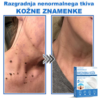 VeruDerm® 2 az 1-ben mikrotűs és hidrokolloid tapasz 🔥 | Kiemelkedő anyajegyek, pattanások, lapos szemölcsök és bőrkinövések ápolására ✅ | Segít javítani a ráncok, hegek és bőrhibák megjelenését ✨ | Láthatatlan pattanástapasz arcra és testre | 144 db 🌸