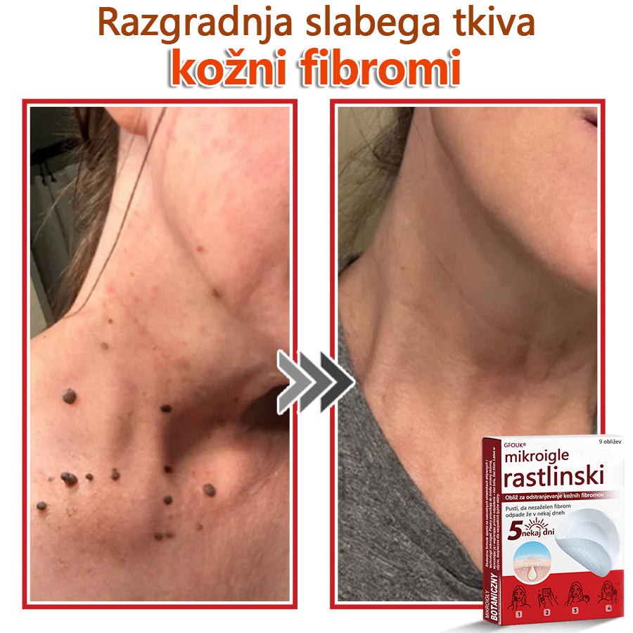 GFOUK® Rastlinski Mikronidling obliži za odstranjevanje kožnih izrastkov✨ – 🩹 Neboleče | 🚫 Brez Brazgotin | 🌿 Naravne Mikroiglice | 🎯 Globinsko Delovanje | 🛡️ Varno za Občutljivo Kožo | 📦 9 kosov | 🇪🇺 Medicinski Razred I |