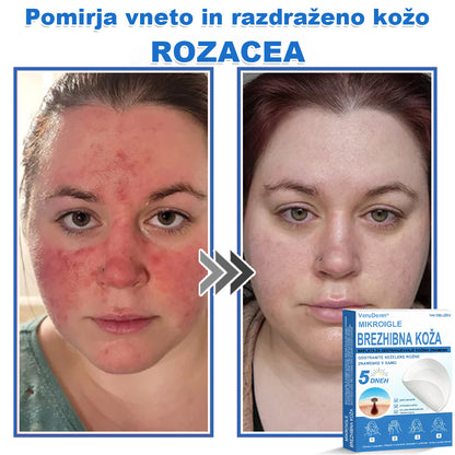 VeruDerm® 2 az 1-ben mikrotűs és hidrokolloid tapasz 🔥 | Kiemelkedő anyajegyek, pattanások, lapos szemölcsök és bőrkinövések ápolására ✅ | Segít javítani a ráncok, hegek és bőrhibák megjelenését ✨ | Láthatatlan pattanástapasz arcra és testre | 144 db 🌸