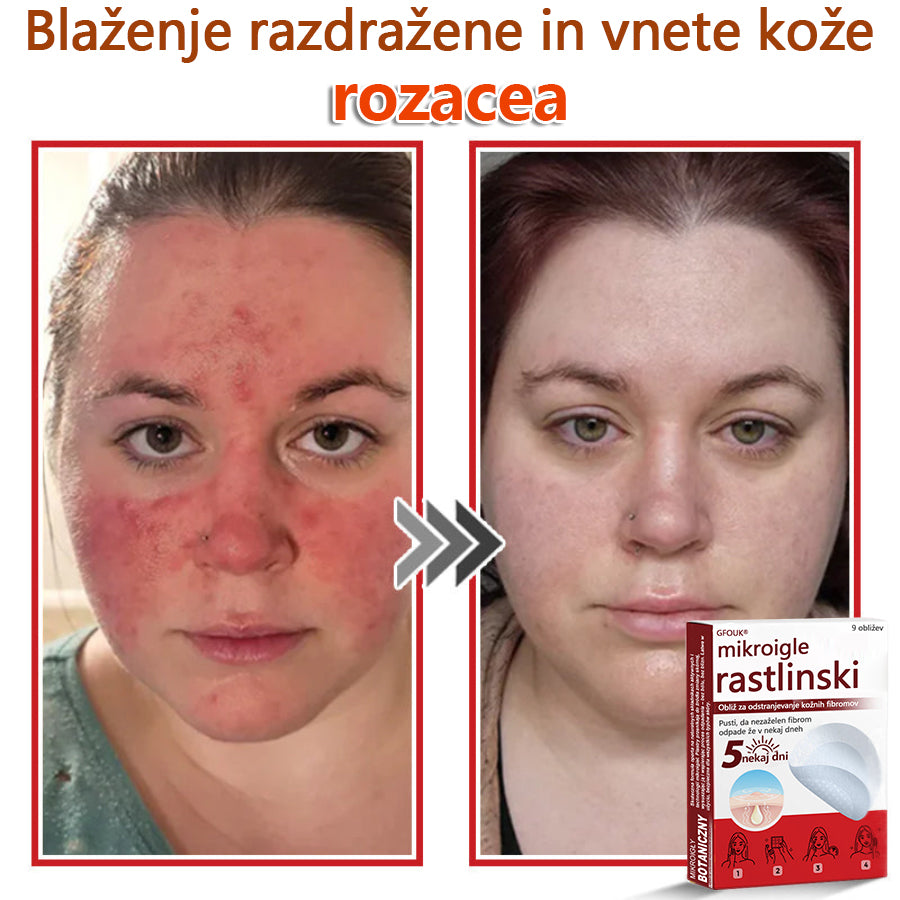 GFOUK® Rastlinski Mikronidling obliži za odstranjevanje kožnih izrastkov✨ – 🩹 Neboleče | 🚫 Brez Brazgotin | 🌿 Naravne Mikroiglice | 🎯 Globinsko Delovanje | 🛡️ Varno za Občutljivo Kožo | 📦 9 kosov | 🇪🇺 Medicinski Razred I |