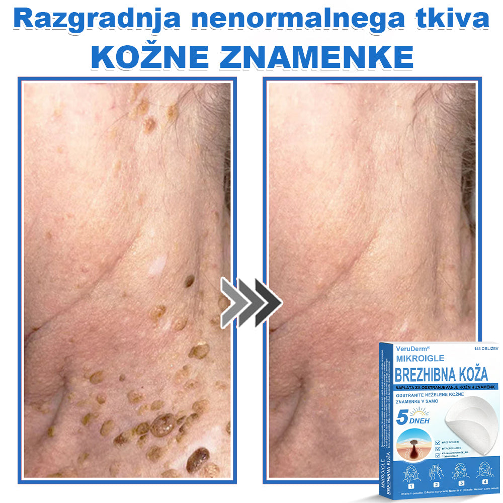VeruDerm® 2 az 1-ben mikrotűs és hidrokolloid tapasz 🔥 | Kiemelkedő anyajegyek, pattanások, lapos szemölcsök és bőrkinövések ápolására ✅ | Segít javítani a ráncok, hegek és bőrhibák megjelenését ✨ | Láthatatlan pattanástapasz arcra és testre | 144 db 🌸