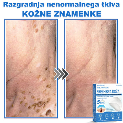 VeruDerm® 2 az 1-ben mikrotűs és hidrokolloid tapasz 🔥 | Kiemelkedő anyajegyek, pattanások, lapos szemölcsök és bőrkinövések ápolására ✅ | Segít javítani a ráncok, hegek és bőrhibák megjelenését ✨ | Láthatatlan pattanástapasz arcra és testre | 144 db 🌸