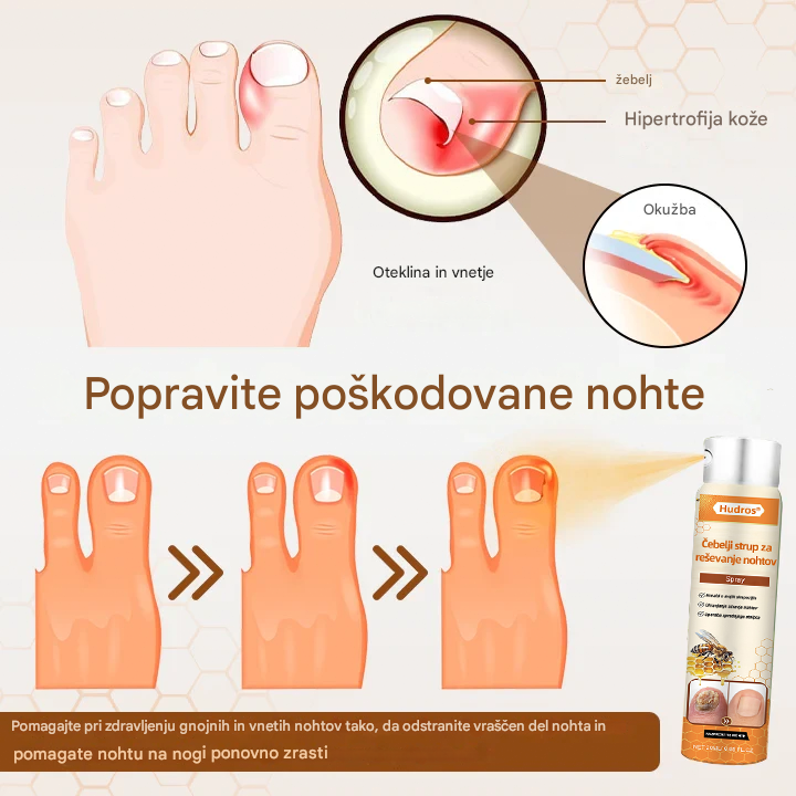 💥 2026 Omejeno 70 % CENEJE ️⏳ Hudros® NailRescue Kolirin pršilo proti glivicam s čebeljim strupom 💥 Vse težave z nohti lahko pozdravite v 2 tednih🐝