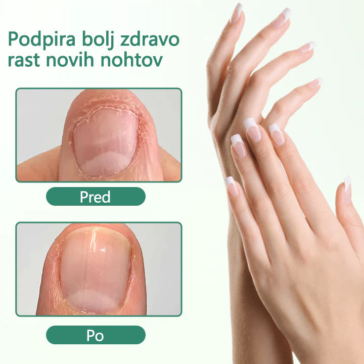 Zelviora® Serum Pen za globinsko nego in obnovo nohtov ✨ Napredna mikro-molekularna formula za obnovo nohtov 💧 Globinsko delovanje ✔️ Podpira zdravo rast nohtov ⏱️ Vidni rezultati v 7–21 dneh 🔥