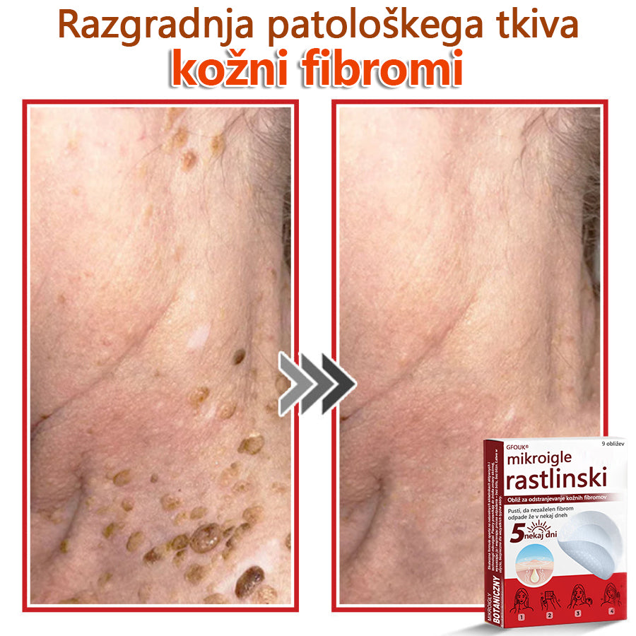 GFOUK® Rastlinski Mikronidling obliži za odstranjevanje kožnih izrastkov✨ – 🩹 Neboleče | 🚫 Brez Brazgotin | 🌿 Naravne Mikroiglice | 🎯 Globinsko Delovanje | 🛡️ Varno za Občutljivo Kožo | 📦 9 kosov | 🇪🇺 Medicinski Razred I |