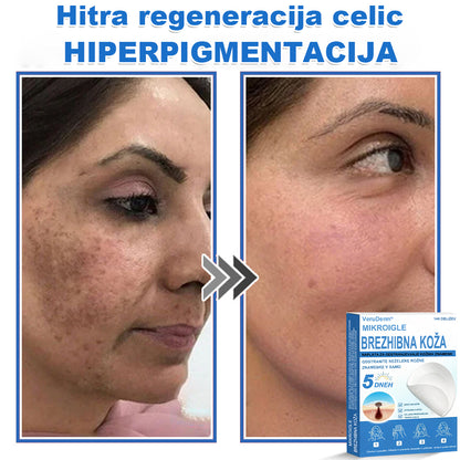 VeruDerm® 2 az 1-ben mikrotűs és hidrokolloid tapasz 🔥 | Kiemelkedő anyajegyek, pattanások, lapos szemölcsök és bőrkinövések ápolására ✅ | Segít javítani a ráncok, hegek és bőrhibák megjelenését ✨ | Láthatatlan pattanástapasz arcra és testre | 144 db 🌸