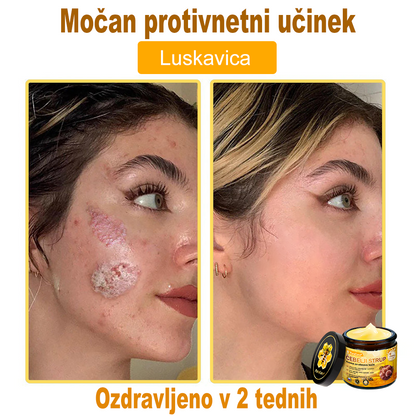 PuraCure® krema za obnovo kože s čebeljim strupom 🐝 | Naravno zdravljenje ekcema, luskavice, dermatitisa in draženja kože | Pomirjujoča in regenerativna formula  🔥