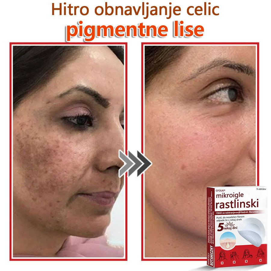 GFOUK® Rastlinski Mikronidling obliži za odstranjevanje kožnih izrastkov✨ – 🩹 Neboleče | 🚫 Brez Brazgotin | 🌿 Naravne Mikroiglice | 🎯 Globinsko Delovanje | 🛡️ Varno za Občutljivo Kožo | 📦 9 kosov | 🇪🇺 Medicinski Razred I |