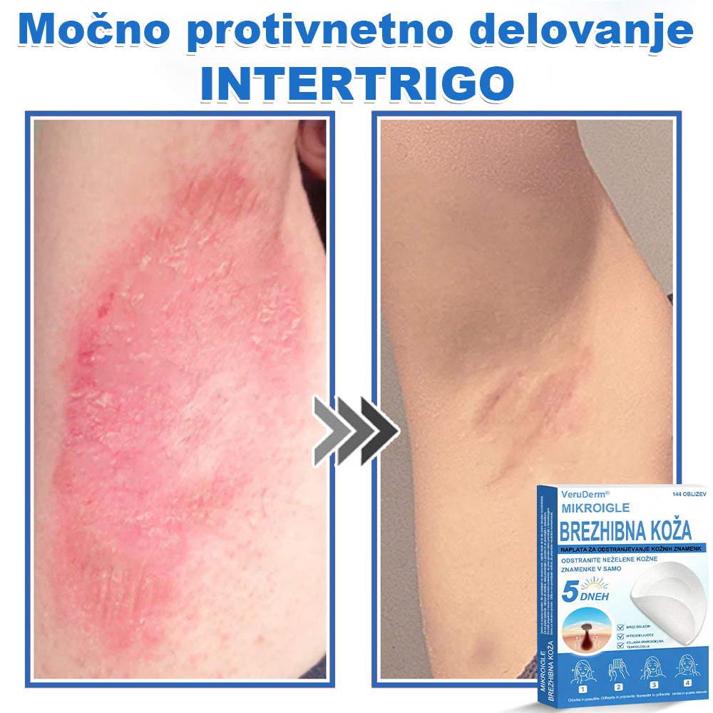 VeruDerm® 2 az 1-ben mikrotűs és hidrokolloid tapasz 🔥 | Kiemelkedő anyajegyek, pattanások, lapos szemölcsök és bőrkinövések ápolására ✅ | Segít javítani a ráncok, hegek és bőrhibák megjelenését ✨ | Láthatatlan pattanástapasz arcra és testre | 144 db 🌸